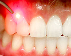 Laser Dentistry