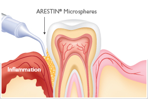 Arestin Carlsbad