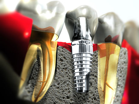 Dental Implants Carlsbad