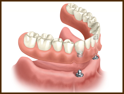 Overdentures Carlsbad