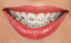 Braces Carlsbad