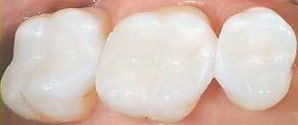 White Fillings Carlsbad